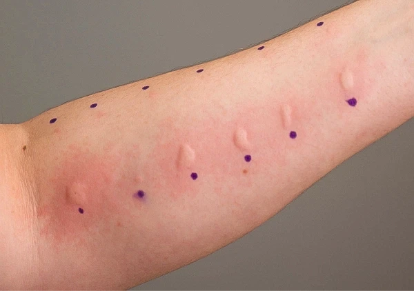 Teste alergico - Dra. Juliana Satin​ - Medicina humanizada e acolhedora